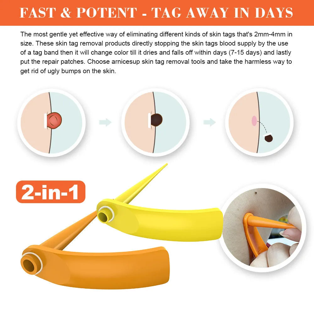 Orange-yellow wart removal tool with rubber rings in two sizes for mole treatment