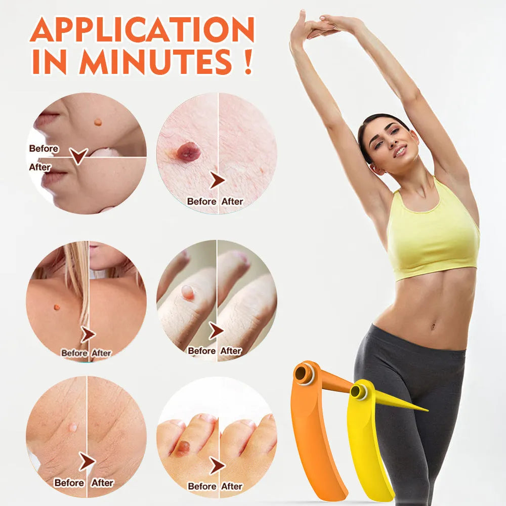Orange-yellow wart removal tool with rubber rings in two sizes for mole treatment