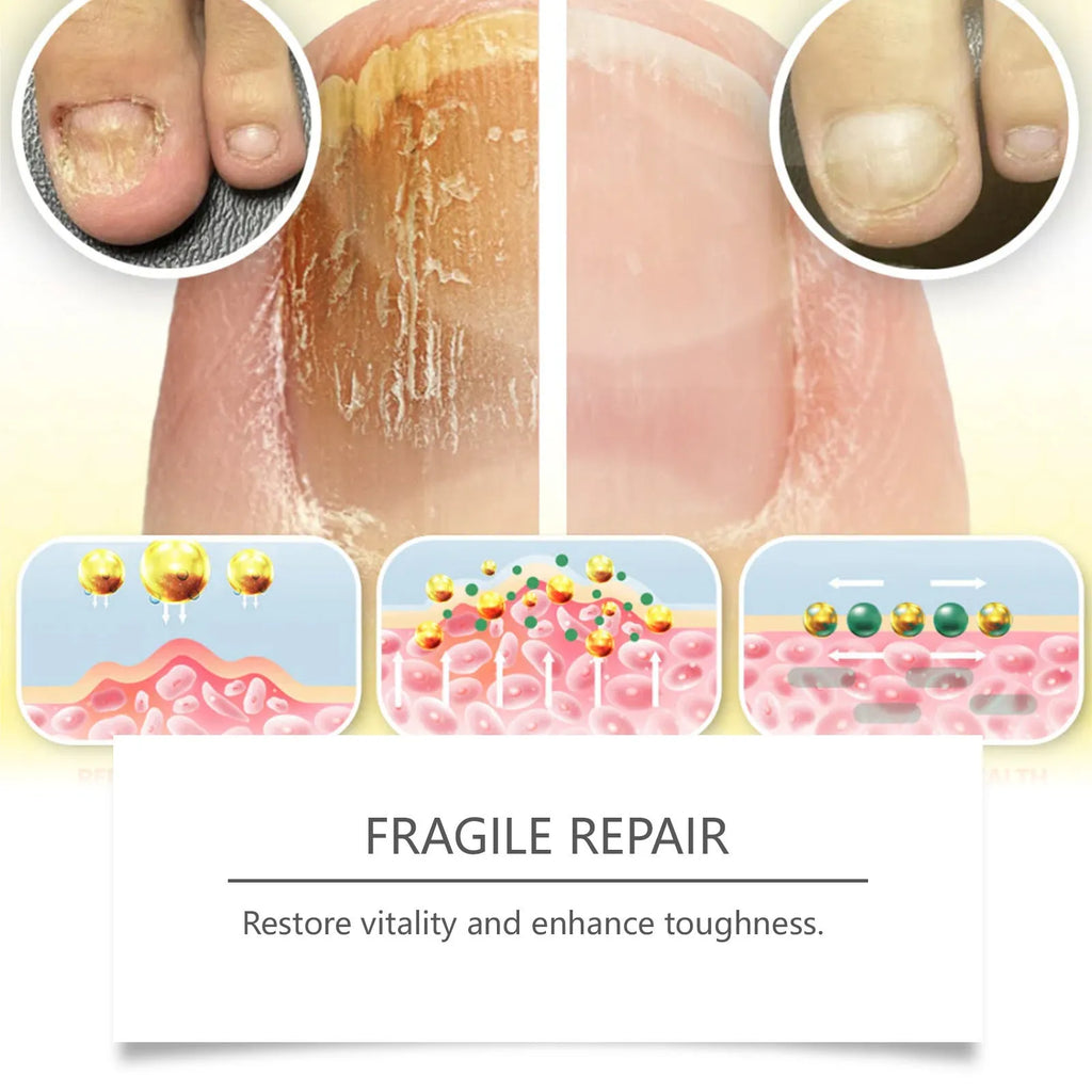 50ml nail care solution bottle with bee venom and peppermint oil for toenails and fingernails