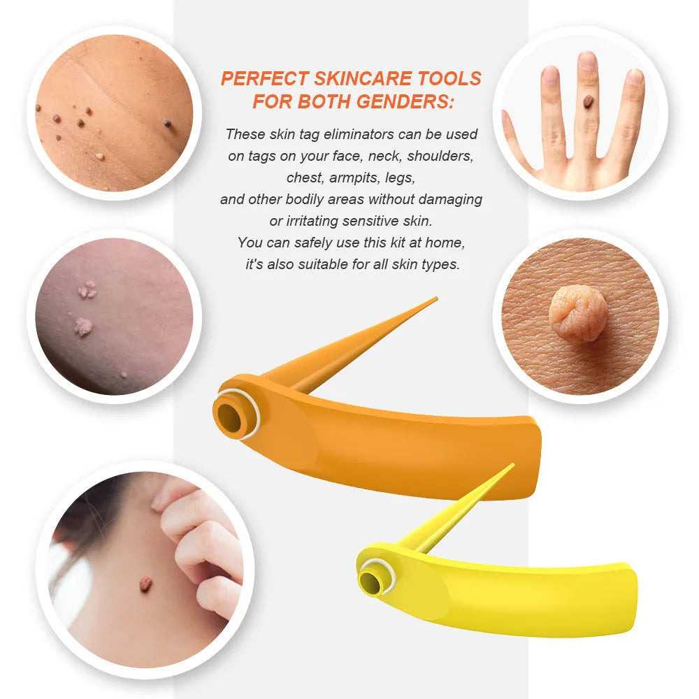 Orange-yellow wart removal tool with rubber rings in two sizes for mole treatment